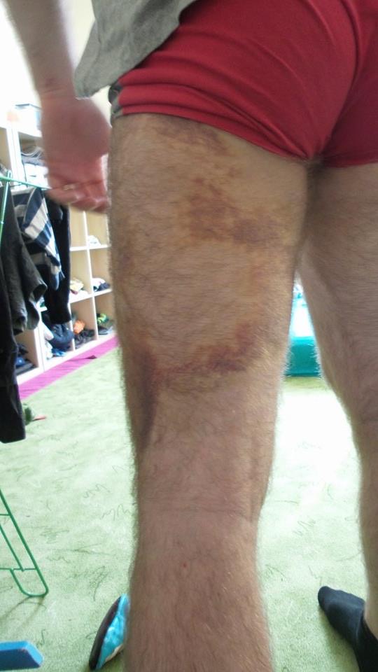 The same thigh in a later customer photo
