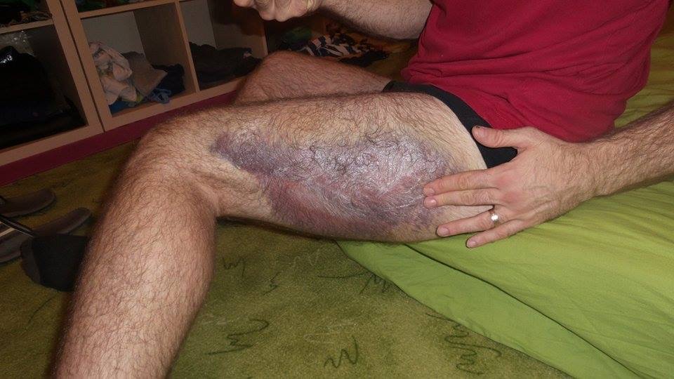 A large bruise on a thigh, customer photo taken before using the products